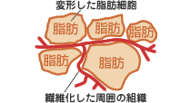 弾力をなくして繊維化